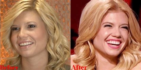 chanel west coast before and after|Chanel West Coast teeth fixed.